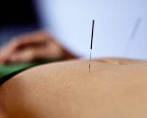 Acupuncture Treatments Woking Acupuncture Treatments Woking