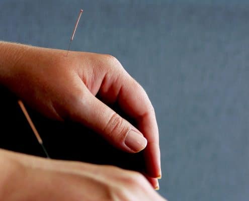 Acupuncture Woking Acupuncture Woking
