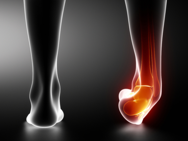 Sprained ankle black x-ray